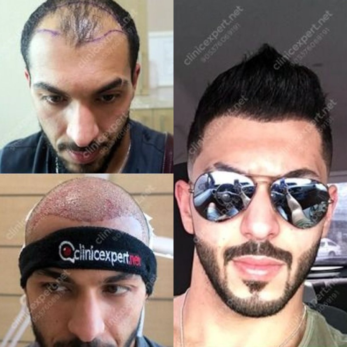 Resultados de trasplante capilar No Shave antes y después en CE International Hospital, línea capilar densa