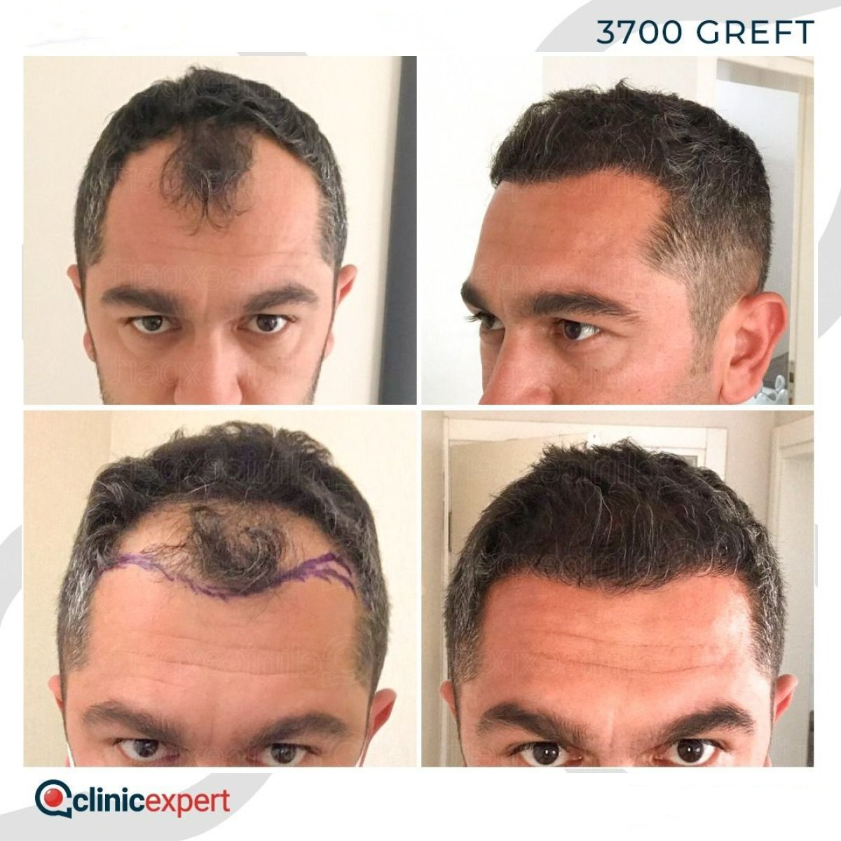 No Shave Hair Transplant before and after results at CE International Hospital, fuller hairline