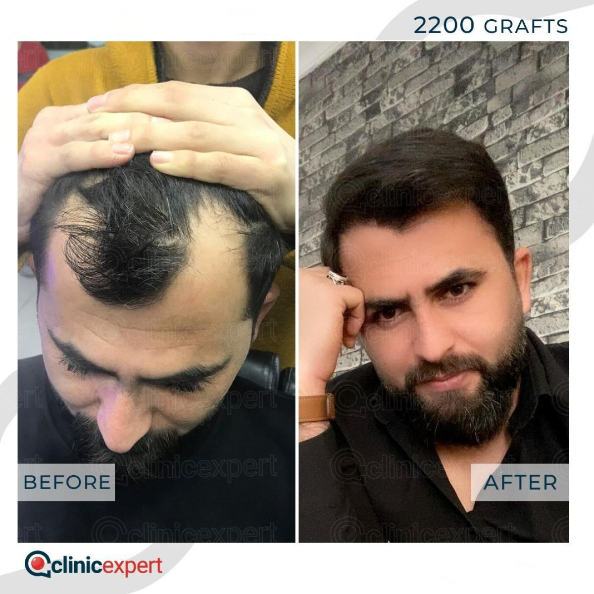 Resultado de trasplante capilar No Shave en CE International Hospital, 2200 injertos