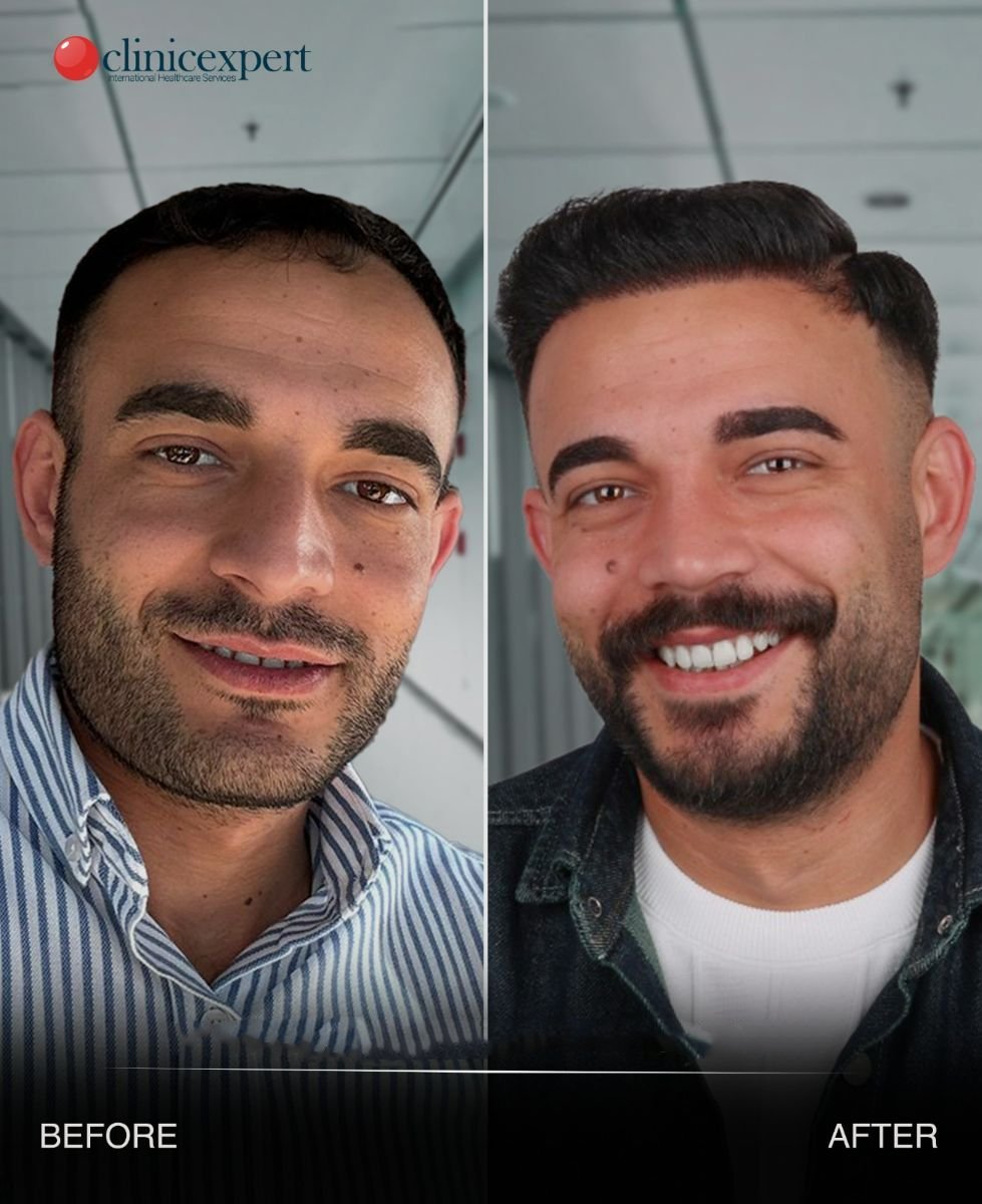 Resultado de trasplante capilar sin rasurar en CE International Hospital, línea de cabello más densa