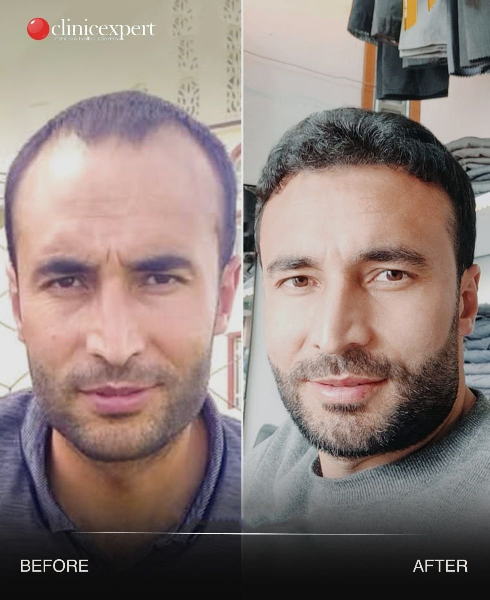 Before and after No Shave Hair Transplant result at CE International Hospital, fuller hairline