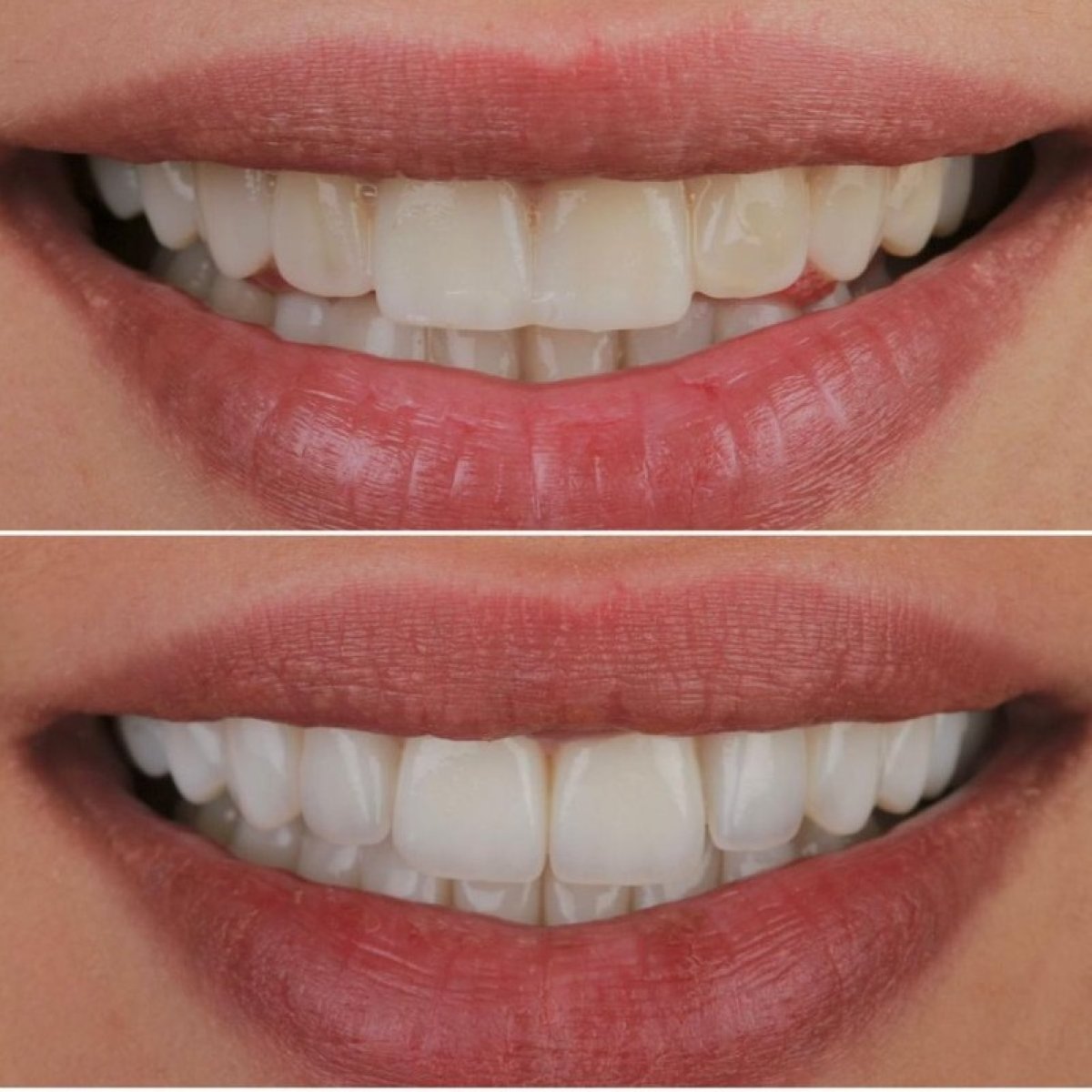 Antes y después de carillas dentales en ÜMRAN TIP MERKEZİ: sonrisa blanca y uniforme