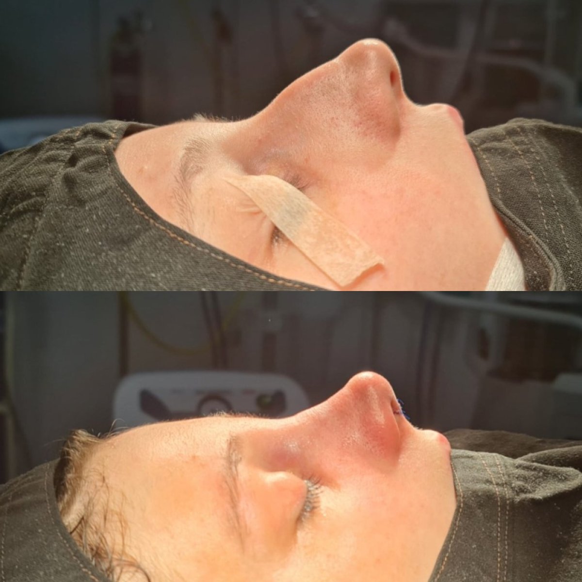 Resultados de rinoplastia antes y después en ÜMRAN TIP MERKEZİ, remodelación nasal