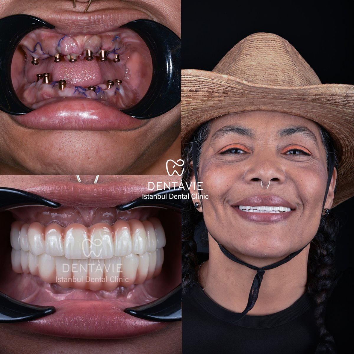 نتيجة قبل وبعد زراعة الأسنان All-on-6 في Dentavie Istanbul Dental Clinic، ابتسامة مستعادة