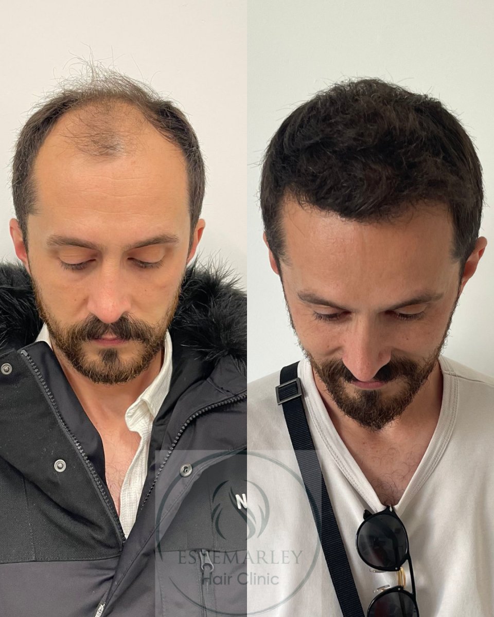 Résultats avant et après greffe de cheveux DHI chez Estemarley – ligne capillaire restaurée