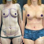 Before and after Breast augmentation photos by Dr. 