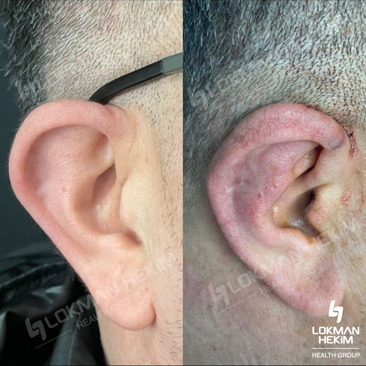 Before and after otoplasty results at Lokman Hekim Istanbul Hospital, ear reshaping surgery