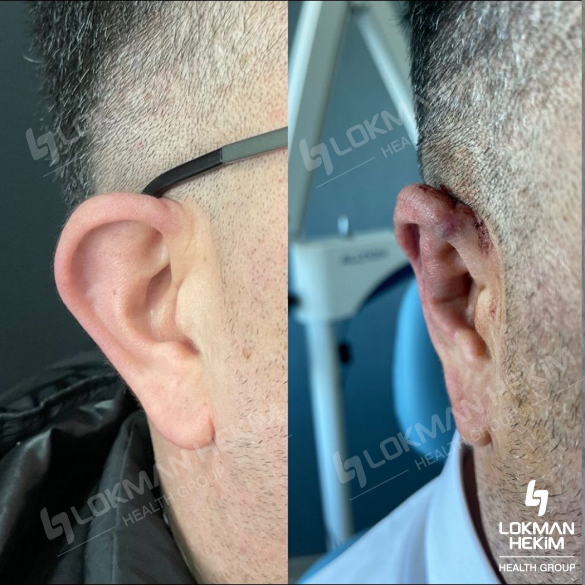 نتائج عملية تجميل الأذن قبل وبعد في مستشفى لوكمان حكيم إسطنبول، إعادة تشكيل الأذن