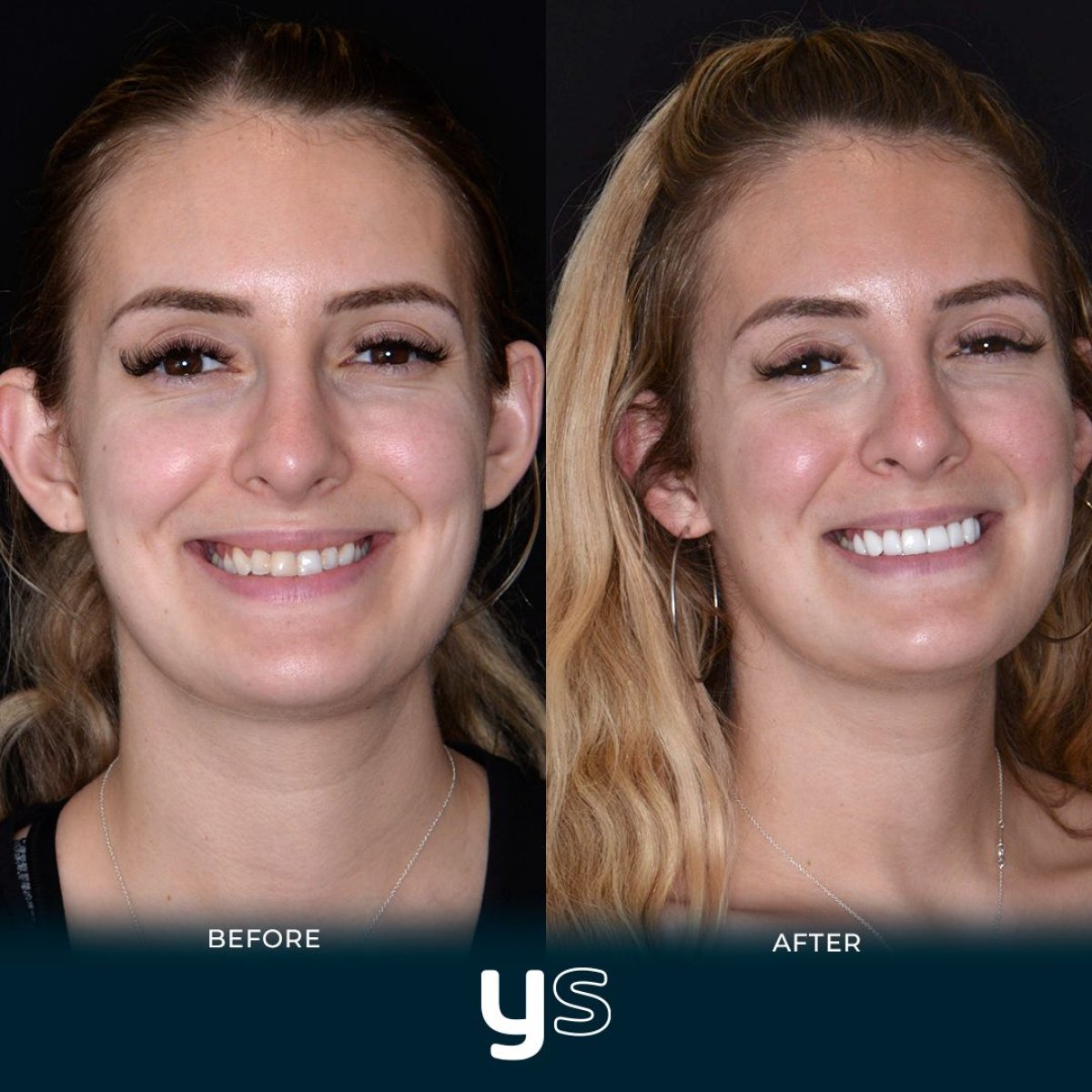 Résultats avant et après bonding dentaire chez YeahSmile, sourire visiblement amélioré