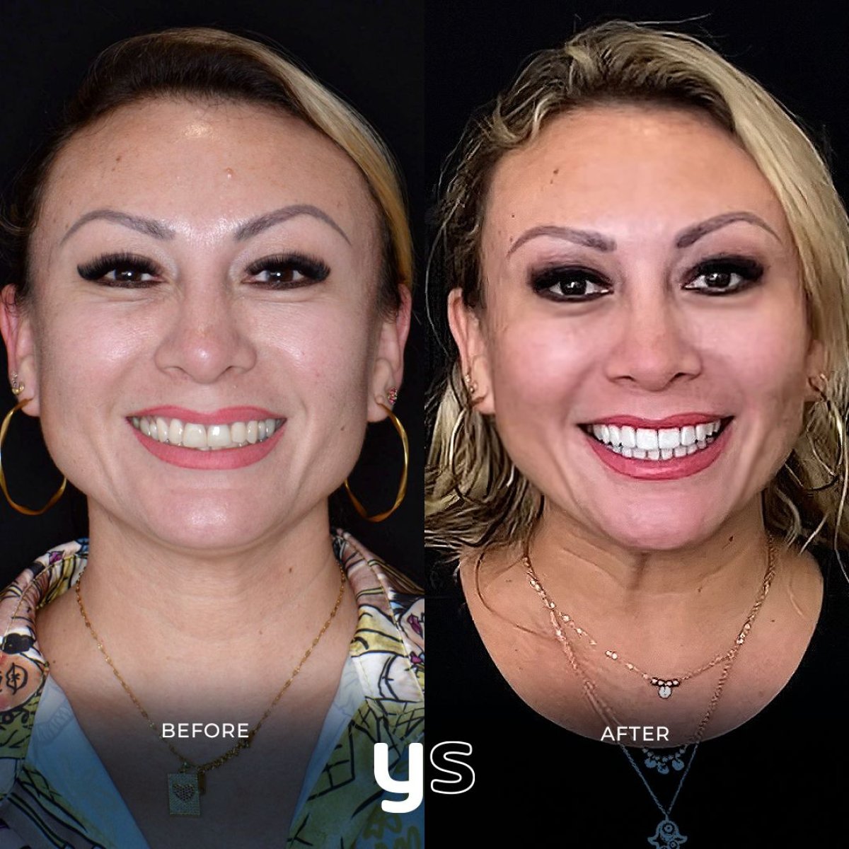 Resultados de antes y después de bonding dental en YeahSmile, sonrisa mejorada y dientes más blancos