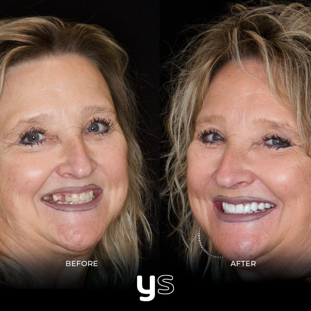 نتائج قبل وبعد ترابط الأسنان في YeahSmile – ابتسامة محسنة وأسنان مستعادة