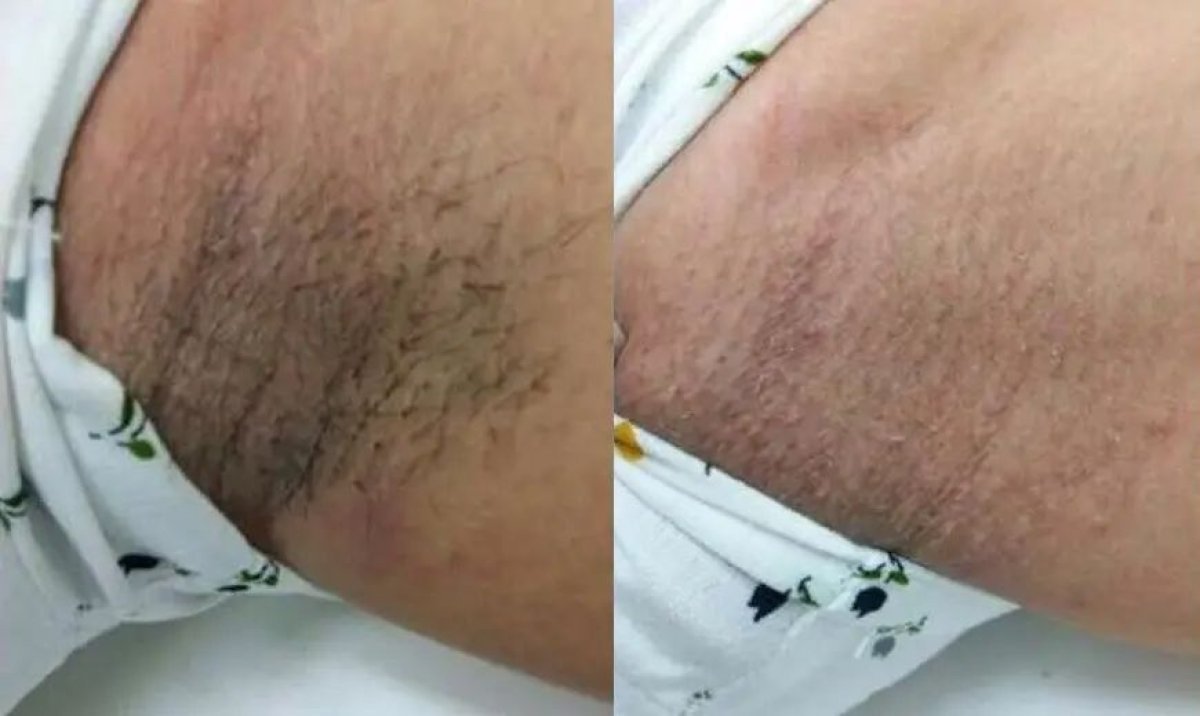 Before and after laser hair removal results at Wansiri Hospital, smoother underarm skin