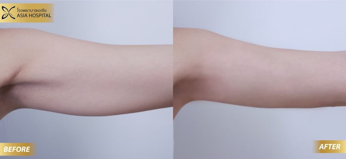 Before and after arm liposuction results at Asia Cosmetic Hospital, visible contour improvement