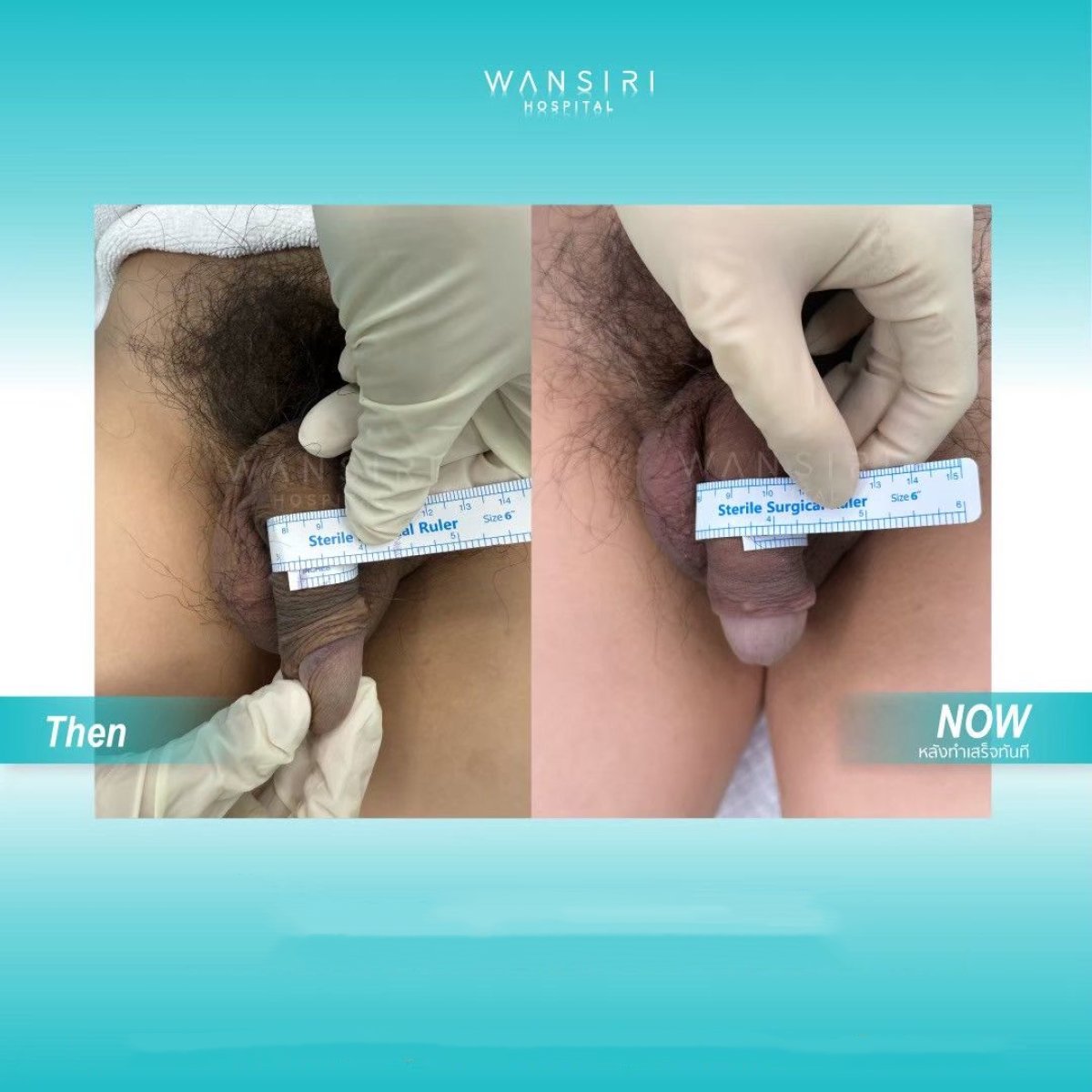 Before and after penis enlargement results at Wansiri Hospital, visible length increase