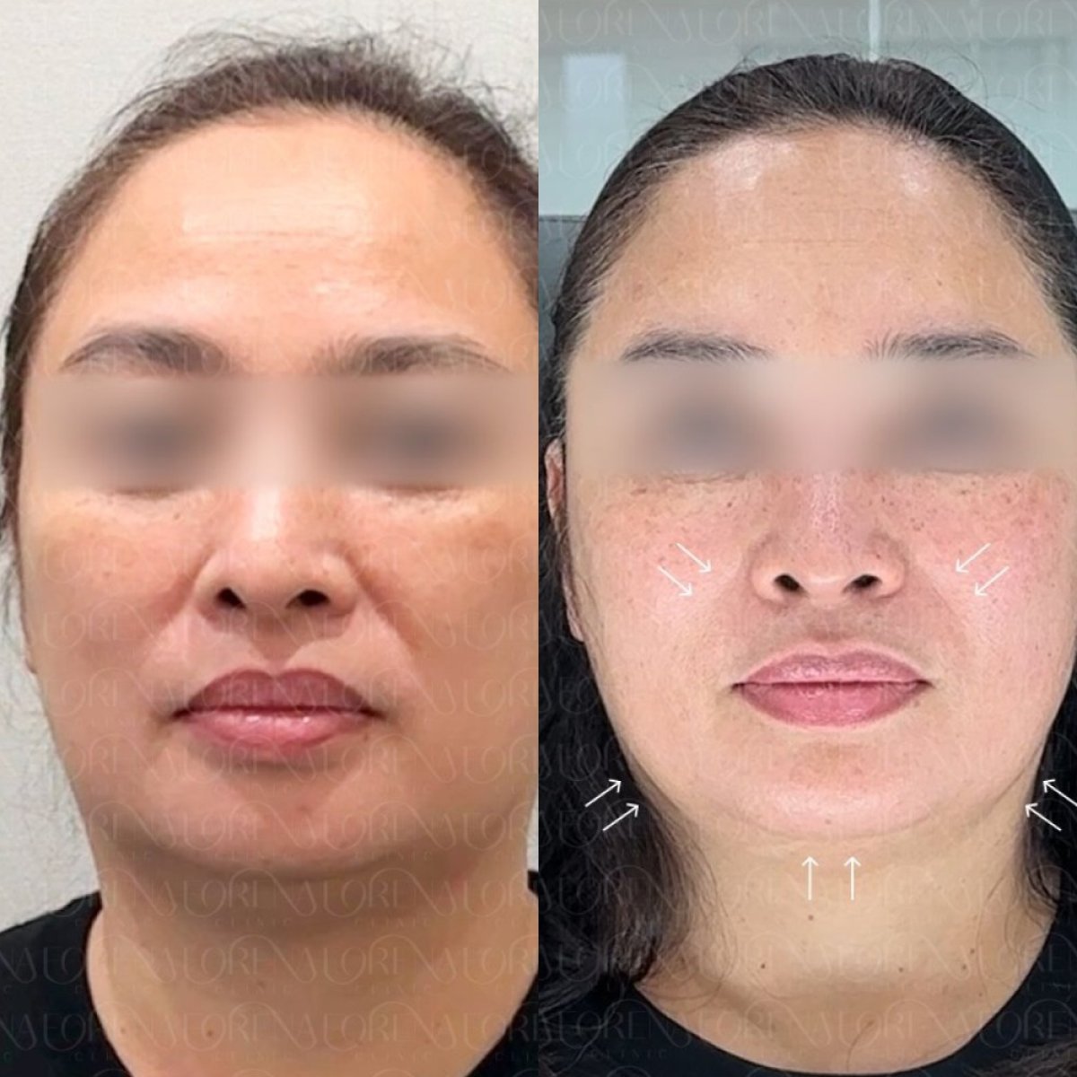 Ultherapy before and after results at Forena Clinic – visible facial lifting and skin tightening