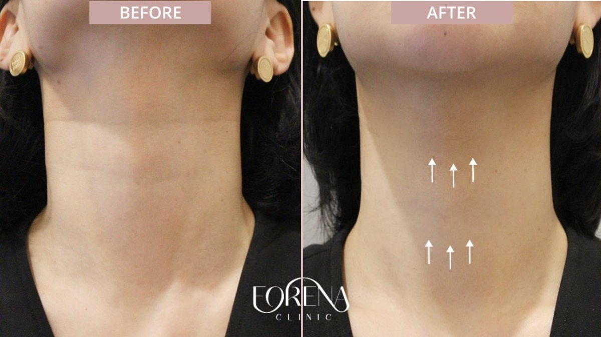 Before and after hyaluronic acid fillers for neck rejuvenation results at Forena Clinic