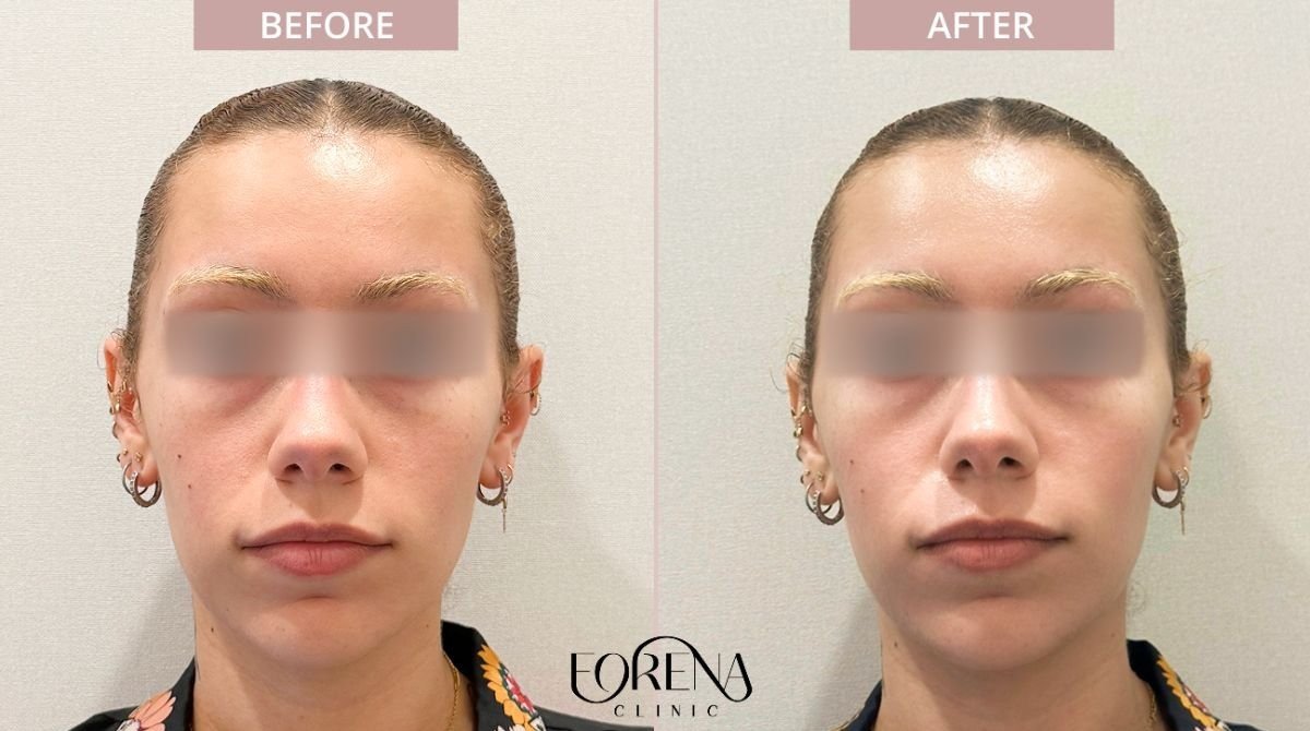 Résultats avant/après rajeunissement de la peau à la Forena Clinic, texture améliorée