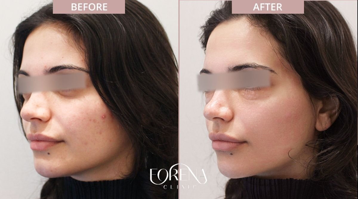 Before and after skin rejuvenation results at Forena Clinic, improved facial skin texture