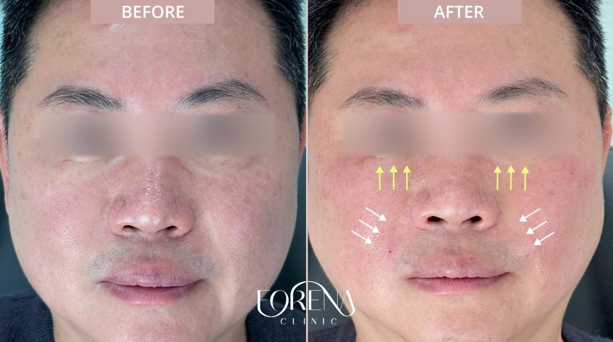 Before and after fillers injection at Forena Clinic, facial volume enhancement result