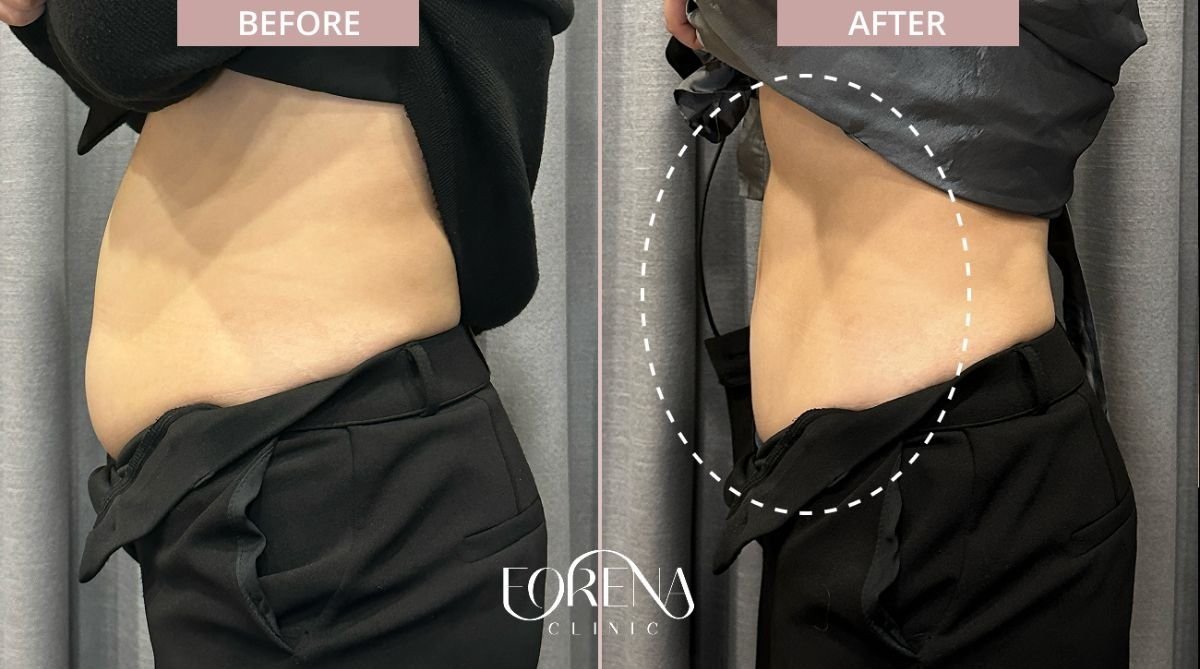 Resultados antes y después de BodyTite en Forena Clinic, abdomen visiblemente más delgado