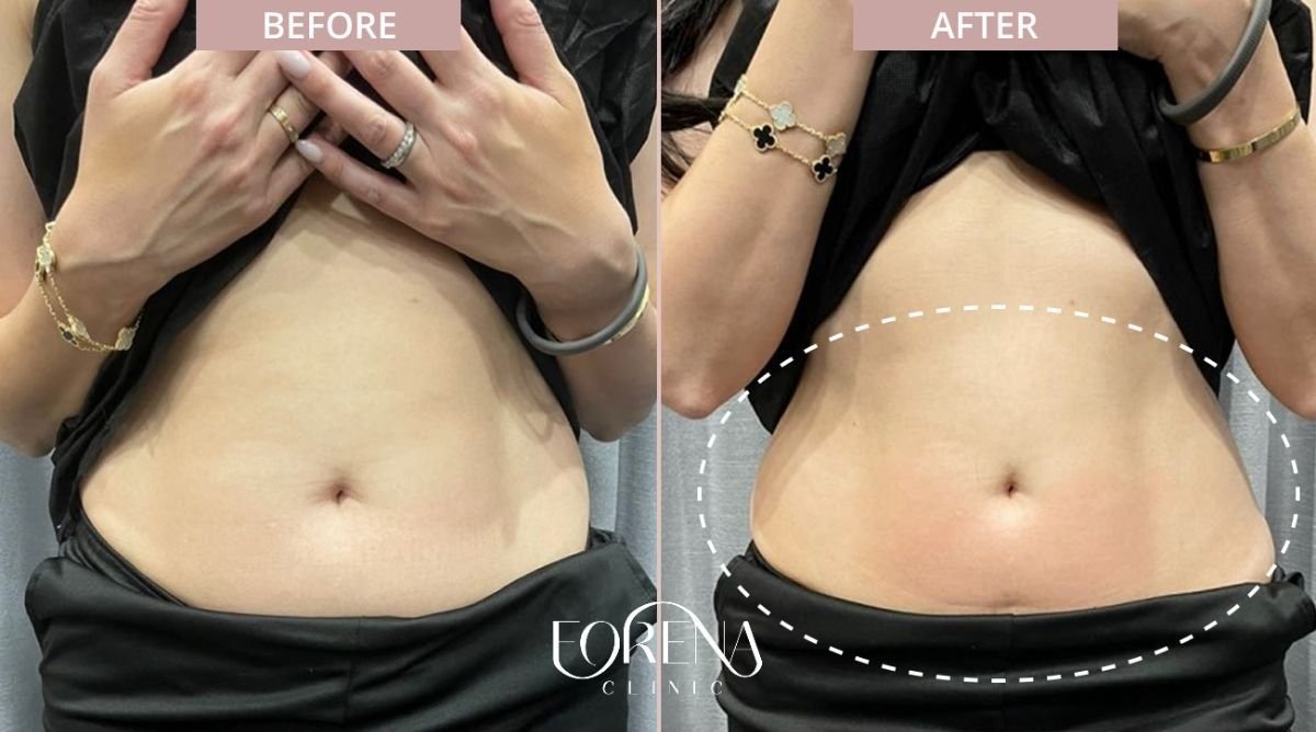 Before and after BodyTite body contouring results at Forena Clinic, visible abdomen slimming