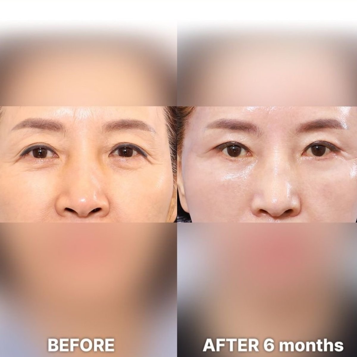 Resultados de blefaroplastia superior antes y después en Returning Plastic Surgery, 6 meses
