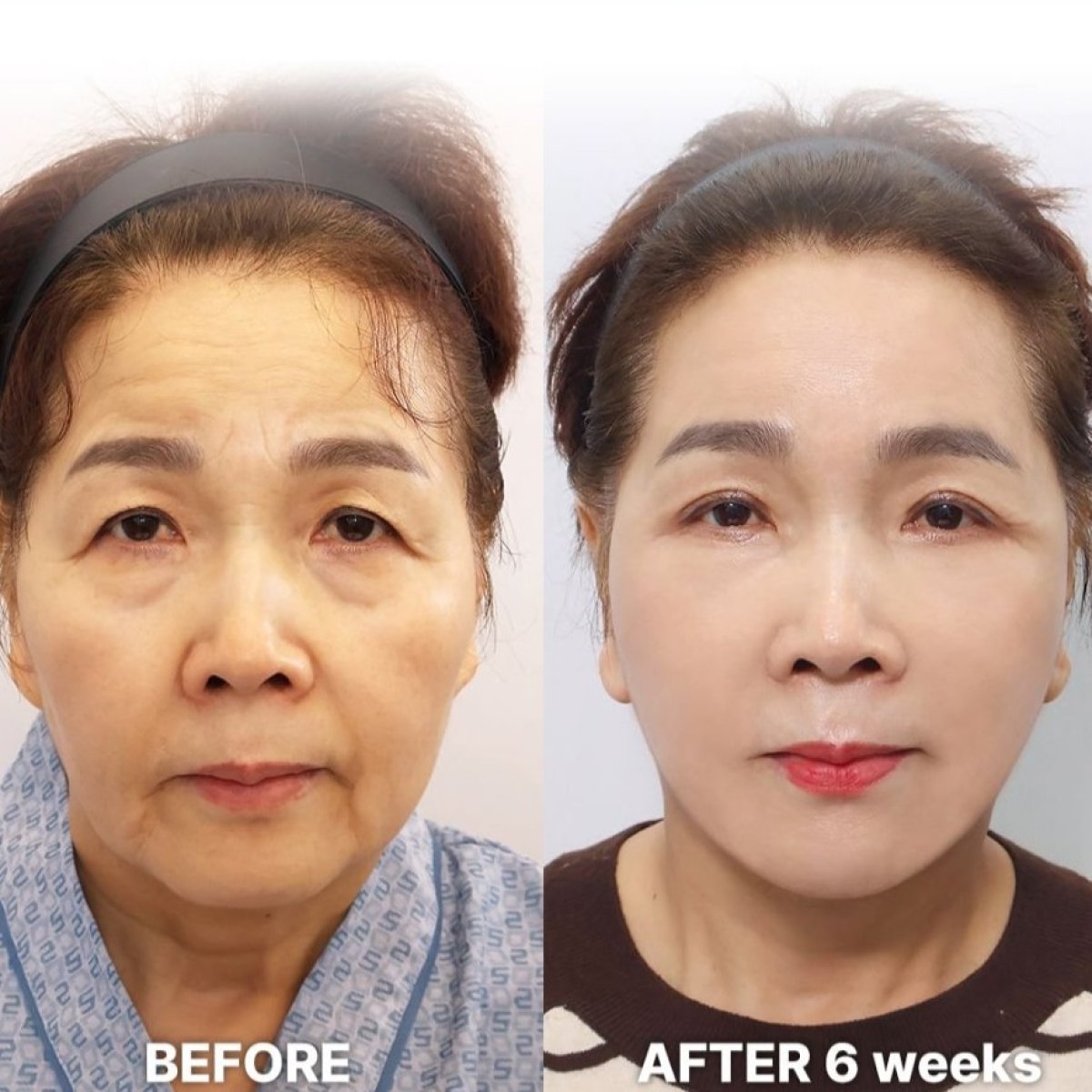 Upper eyelid surgery before and after results at Returning Plastic Surgery, 6 weeks post-op