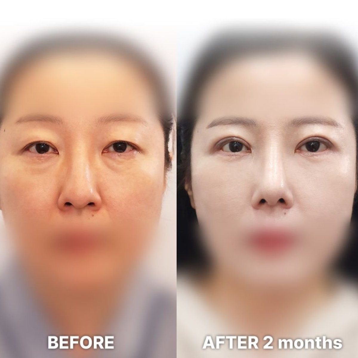 Resultados de blefaroplastia superior antes y después en Returning Plastic Surgery, 2 meses