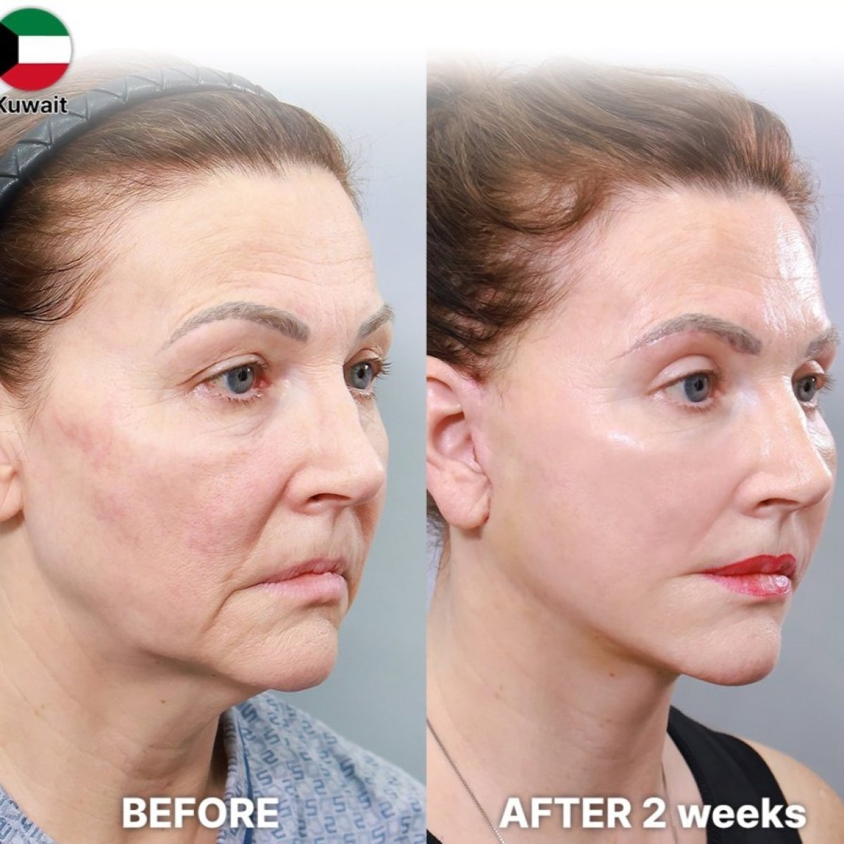 Before and after lower eyelid blepharoplasty results at Returning Plastic Surgery clinic