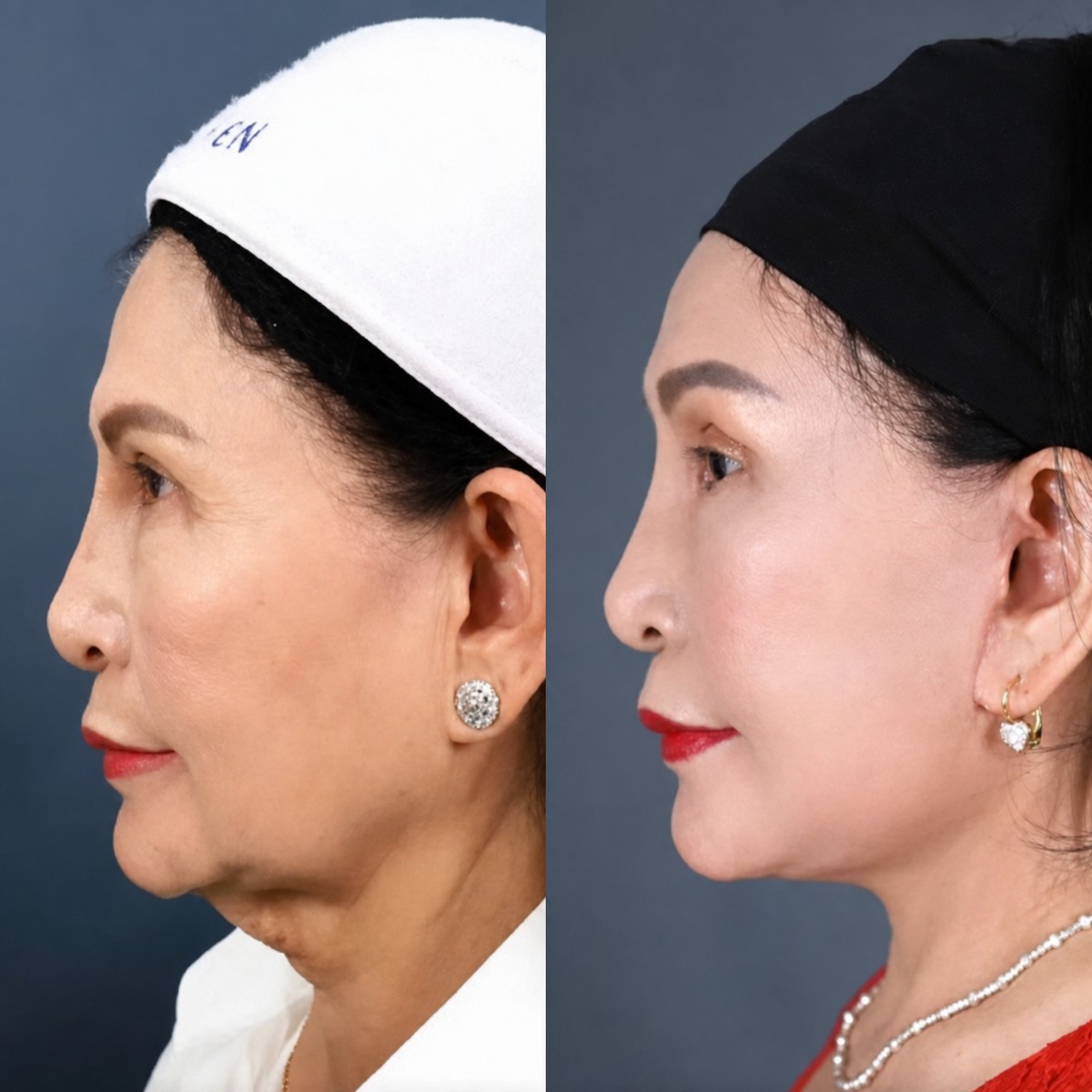 Résultats avant/après mini lifting au Dr. Chen Surgery Hospital International Center, rajeunissement du visage
