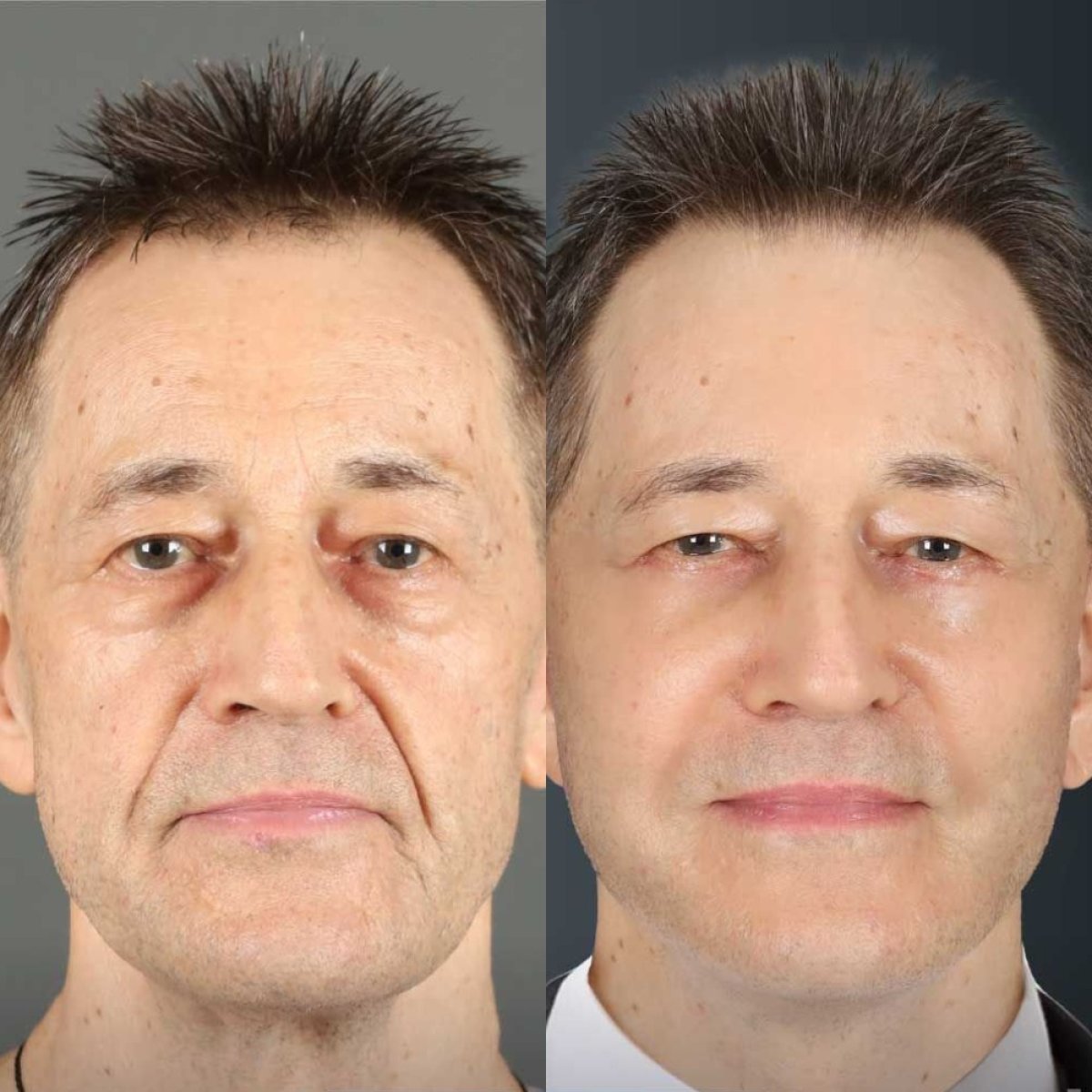 Resultados de minilifting facial antes y después en Dr. Chen Surgery Hospital International Center, rejuvenecimiento