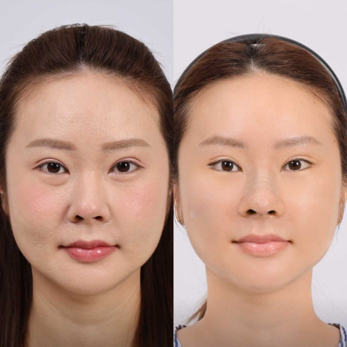 Resultados de minilifting facial antes y después en Dr. Chen Surgery Hospital International Center