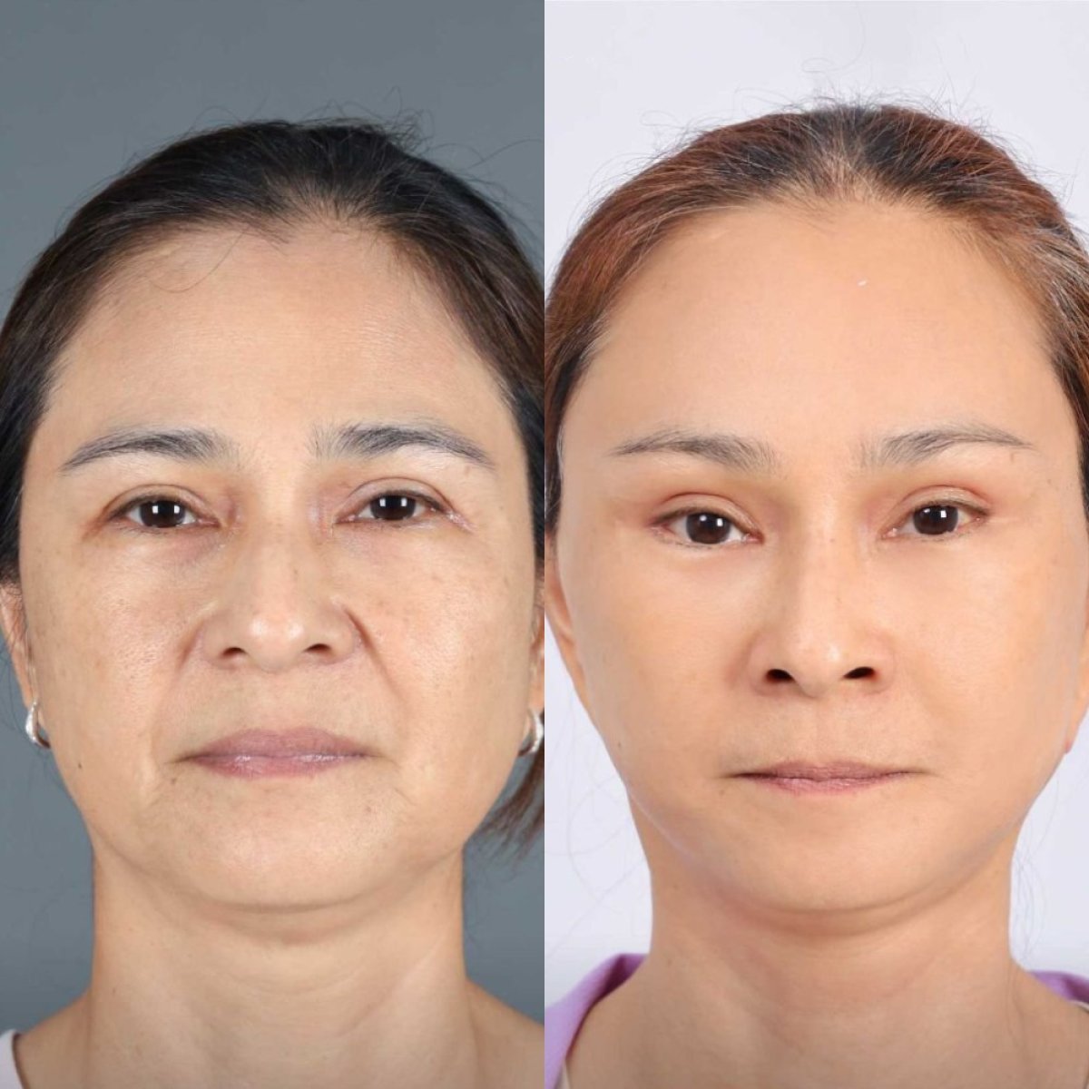 Resultados de minilifting facial antes y después en Dr. Chen Surgery Hospital International Center, rejuvenecimiento