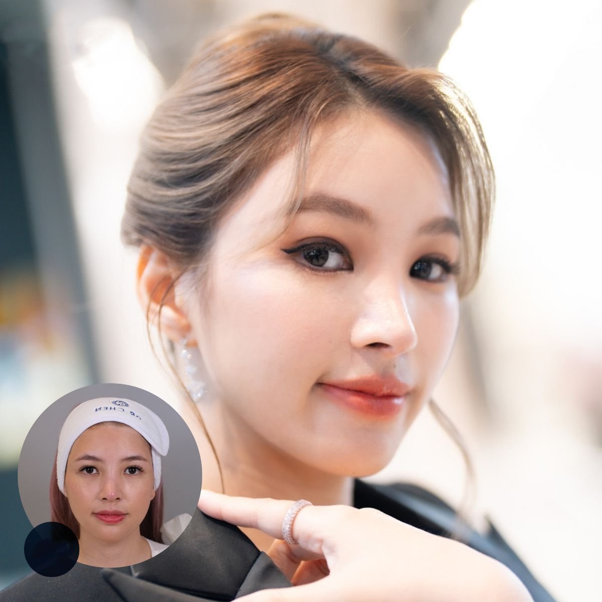 Resultados de minilifting facial antes y después en Dr. Chen Surgery Hospital International Center