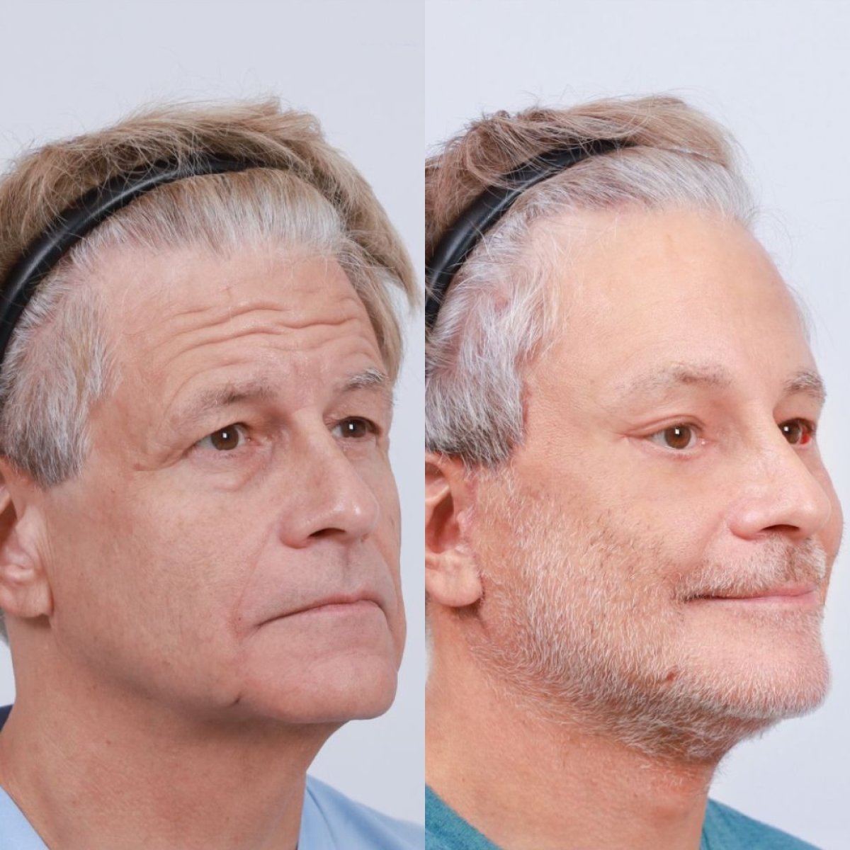 Résultats avant et après mini lifting au Dr. Chen Surgery Hospital International Center, rajeunissement du visage