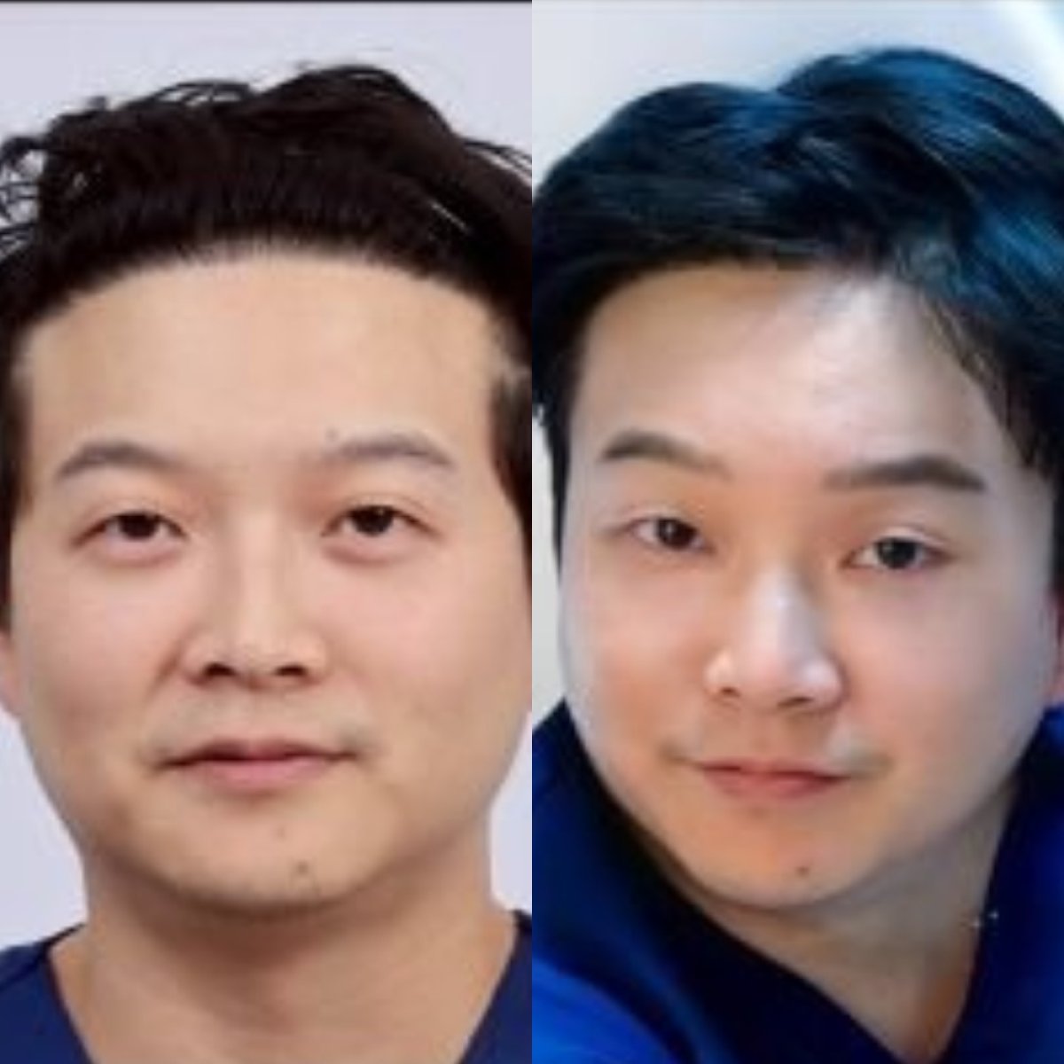 Resultados de minilifting facial antes y después en Dr. Chen Surgery Hospital International Center