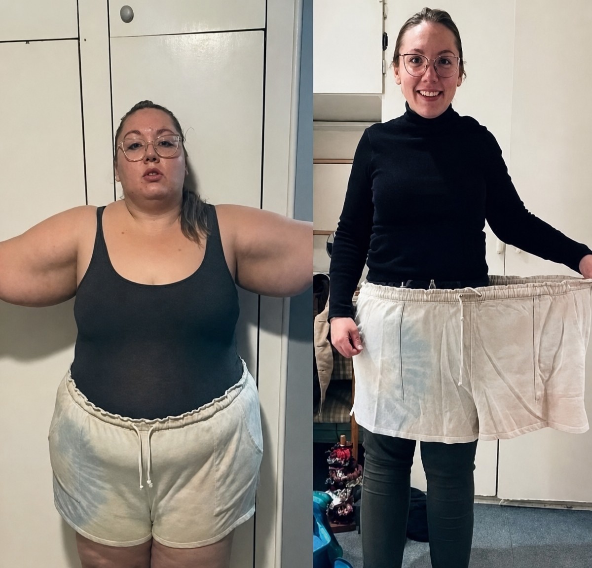Before and after gastric sleeve surgery results at Büyük Anadolu Hospitals (BAH), significant weight loss