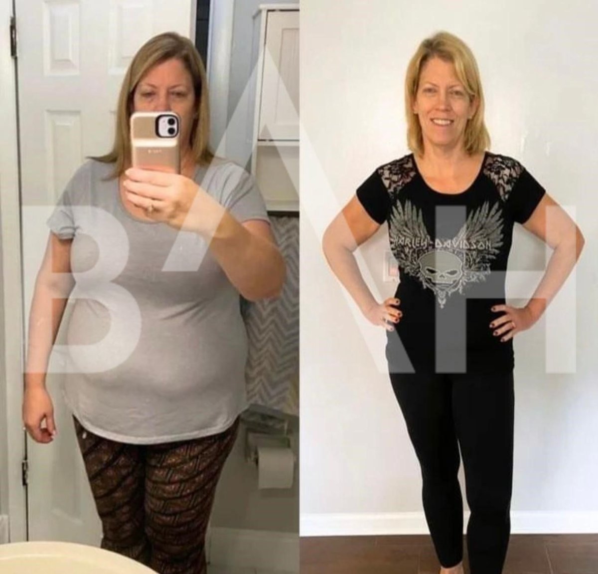 Before and after gastric balloon results at Büyük Anadolu Hospitals (BAH), visible weight loss