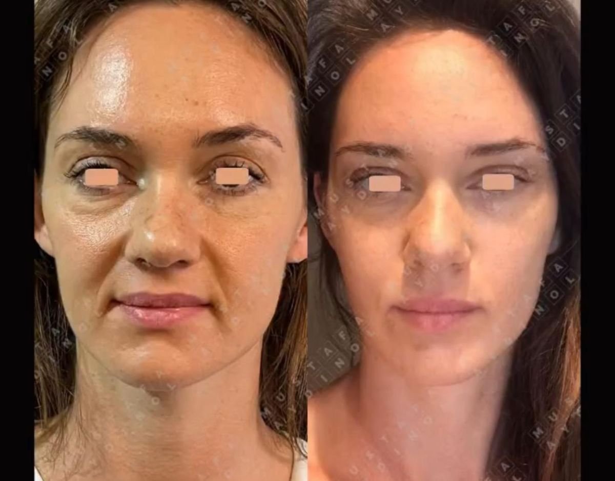 Resultados de lifting facial antes y después en Dr. MED – rostro más liso y juvenil