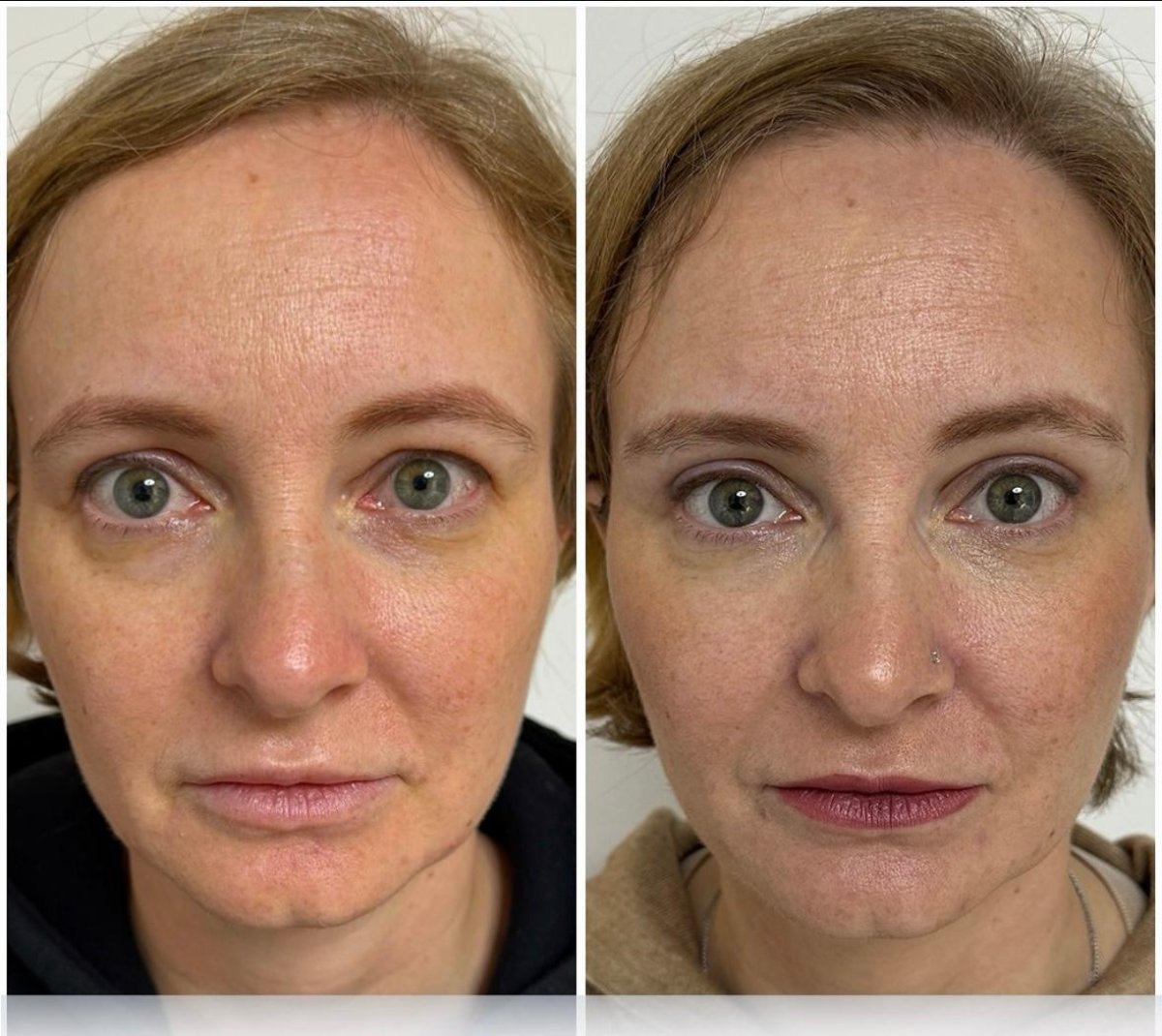 Antes y después de blefaroplastia en ÜMRAN TIP MERKEZİ, resultado visible en párpados