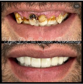 All-on-4 OSSTEM Dental Implants — Complete 6-Day Treatment in Ankara - photo 5