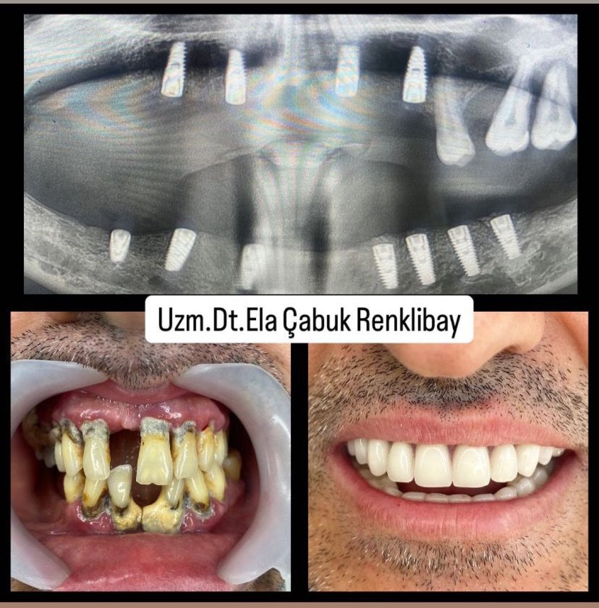Dental implant before and after results at Dr. Ela Cabuk Renklibay's Private Dental Clinic