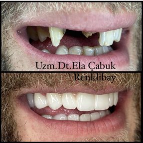 All-on-4 OSSTEM Dental Implants — Complete 6-Day Treatment in Ankara - photo 4