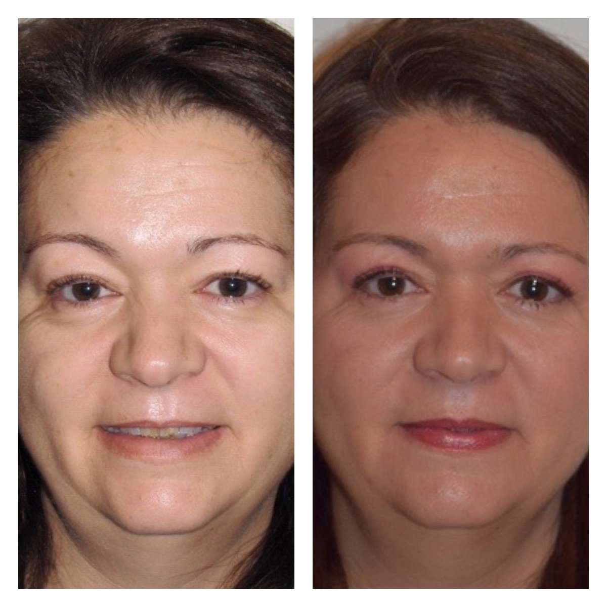 Antes y después de transferencia de grasa facial en Clinica Granado Tiagonce, resultados rejuvenecedores