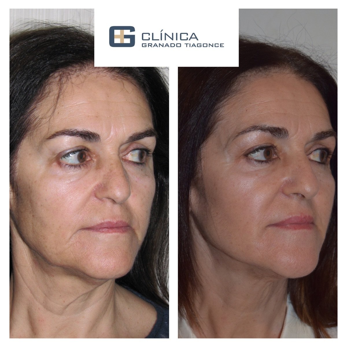 Vorher-nachher-Ergebnis des Facial Fat Transfer in der Clinica Granado Tiagonce, verjüngtes Aussehen