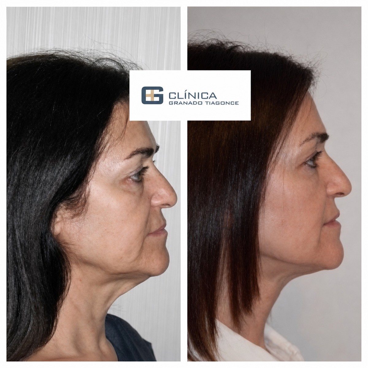 Antes y después de lipofilling facial en Clinica Granado Tiagonce, resultado rejuvenecedor