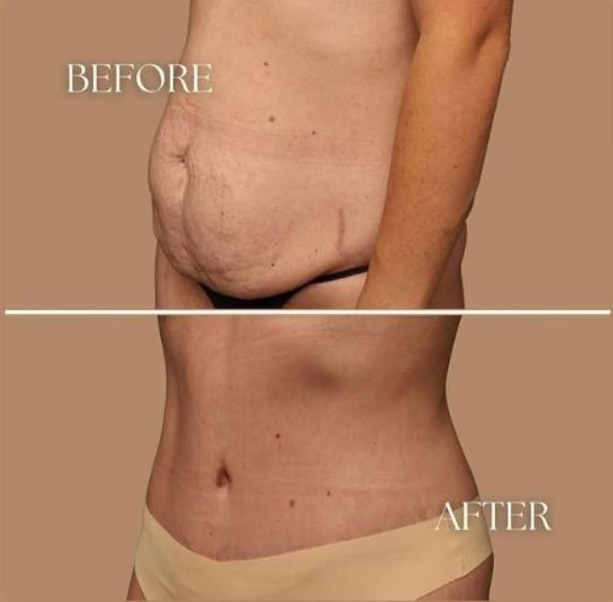 Before and after tummy tuck results at Medical Park Antalya Hospital Complex, flatter abdomen