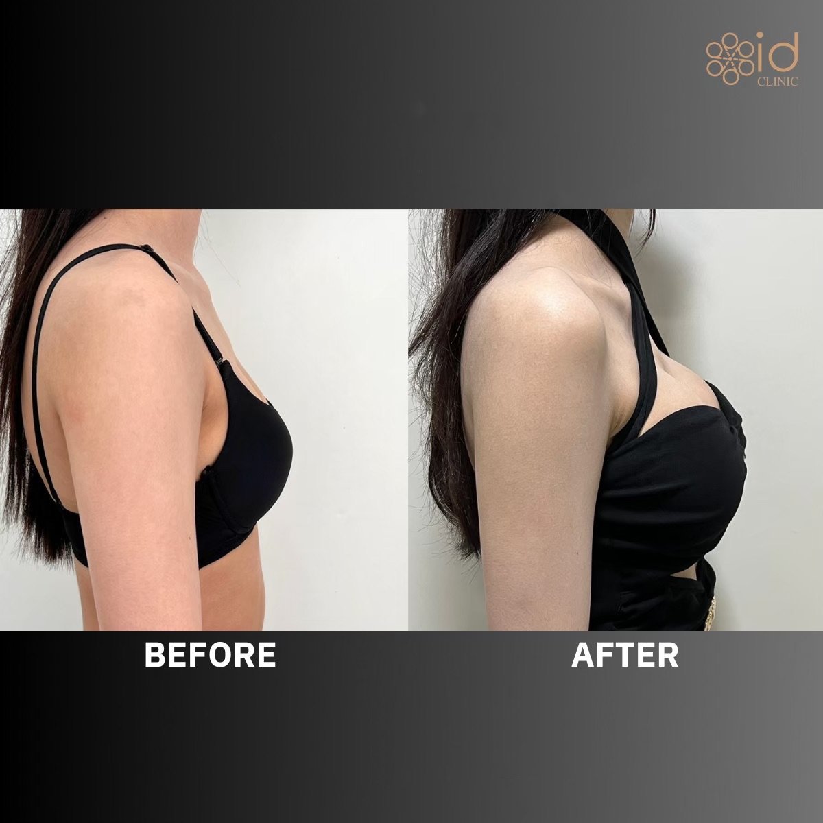 Before and after breast augmentation results at ID Clinic Bangkok, enhanced breast shape