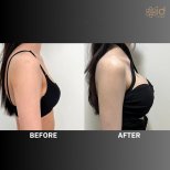 Before and after Breast augmentation photos by Dr. Dr Phatcharasak Kraisornphongsakul Md