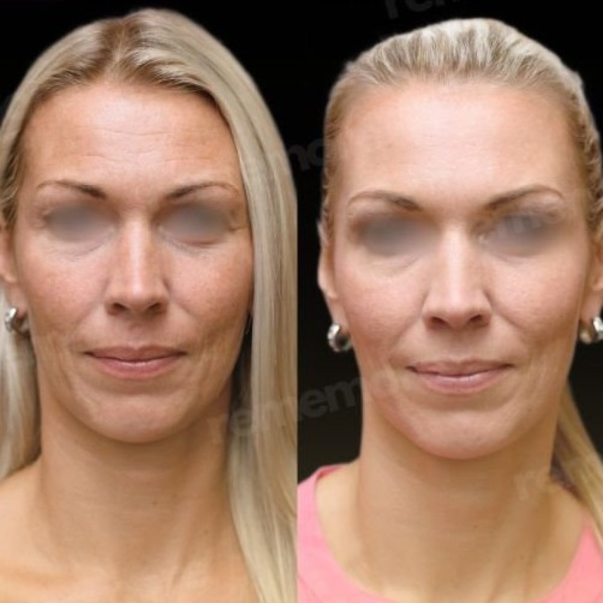 Resultados de feminización facial antes y después en Memorial Bahçelievler Hospital